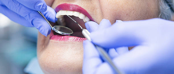 Best Knocked-Out Tooth (Avulsed Tooth) Treatment in Reese, MI